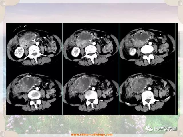 【病例】腹腔侵袭性纤维瘤病1例CT影像表现 【病例】腹腔侵袭性纤维瘤病1例CT影像表现