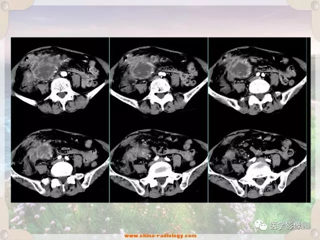 【病例】腹腔侵袭性纤维瘤病1例CT影像表现 【病例】腹腔侵袭性纤维瘤病1例CT影像表现