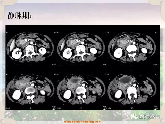 【病例】腹腔侵袭性纤维瘤病1例CT影像表现 【病例】腹腔侵袭性纤维瘤病1例CT影像表现