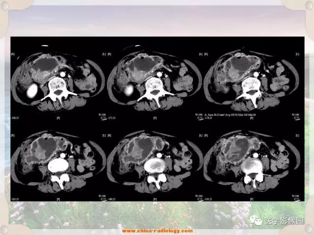【病例】腹腔侵袭性纤维瘤病1例CT影像表现 【病例】腹腔侵袭性纤维瘤病1例CT影像表现
