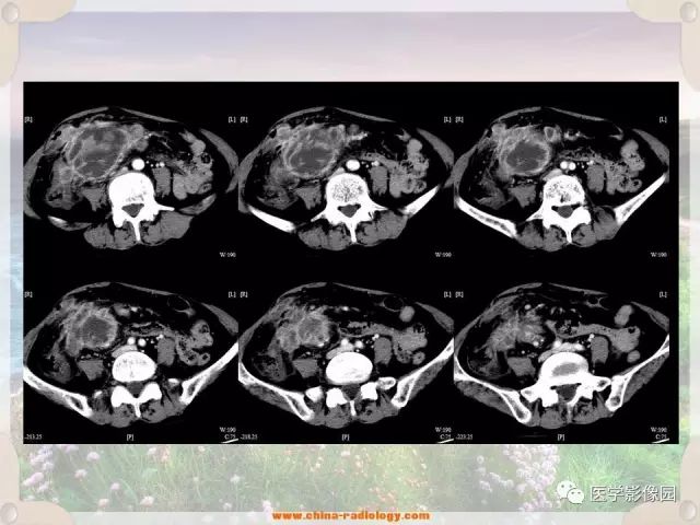 【病例】腹腔侵袭性纤维瘤病1例CT影像表现 【病例】腹腔侵袭性纤维瘤病1例CT影像表现