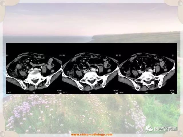 【病例】腹腔侵袭性纤维瘤病1例CT影像表现 【病例】腹腔侵袭性纤维瘤病1例CT影像表现