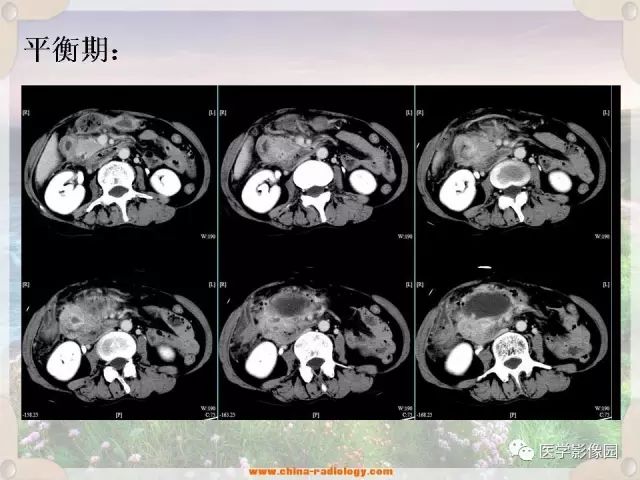 【病例】腹腔侵袭性纤维瘤病1例CT影像表现 【病例】腹腔侵袭性纤维瘤病1例CT影像表现
