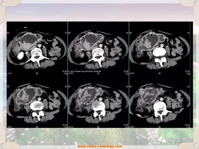 【病例】腹腔侵袭性纤维瘤病1例CT影像表现 【病例】腹腔侵袭性纤维瘤病1例CT影像表现