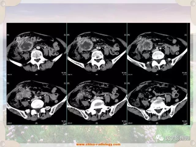 【病例】腹腔侵袭性纤维瘤病1例CT影像表现 【病例】腹腔侵袭性纤维瘤病1例CT影像表现
