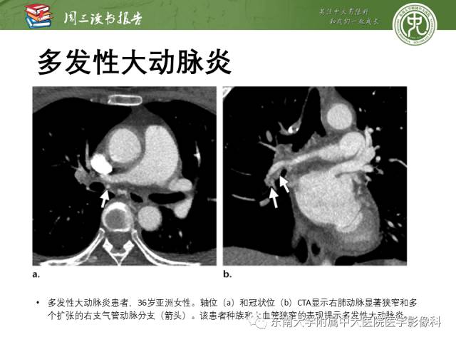【PPT】支气管动脉：解剖、功能及增粗和异常改变
