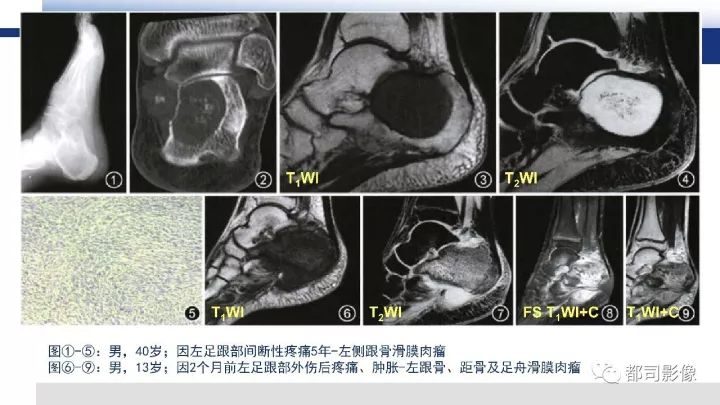 【病例】右腋下滑膜肉瘤1例影像诊断