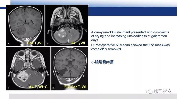 【病例】右腋下滑膜肉瘤1例影像诊断
