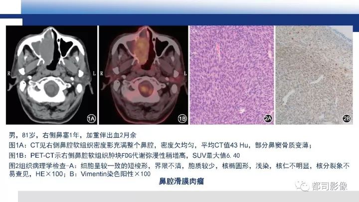 【病例】右腋下滑膜肉瘤1例影像诊断