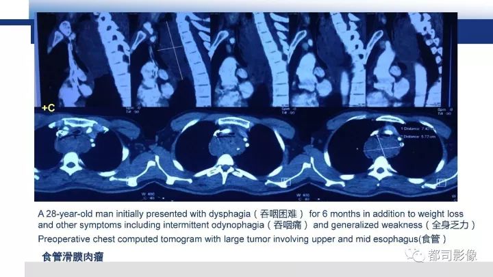 【病例】右腋下滑膜肉瘤1例影像诊断