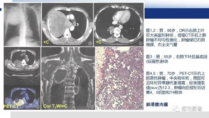 【病例】右腋下滑膜肉瘤1例影像诊断