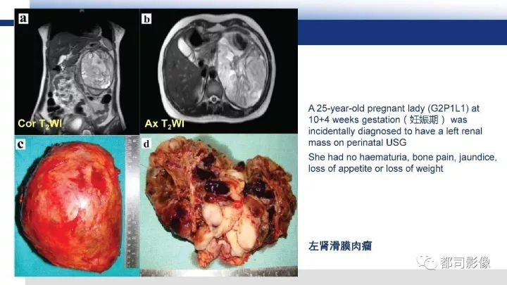 【病例】右腋下滑膜肉瘤1例影像诊断