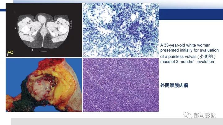 【病例】右腋下滑膜肉瘤1例影像诊断