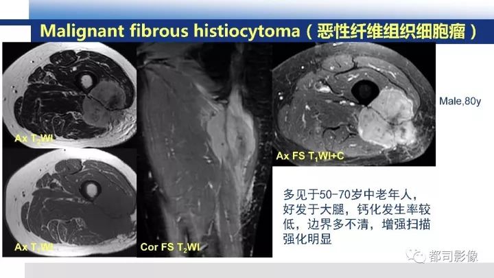 【病例】右腋下滑膜肉瘤1例影像诊断