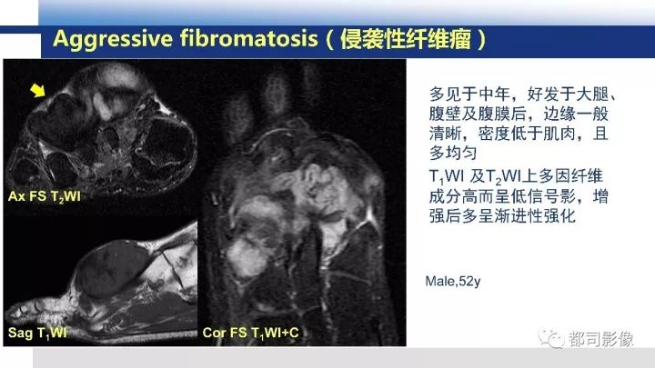 【病例】右腋下滑膜肉瘤1例影像诊断