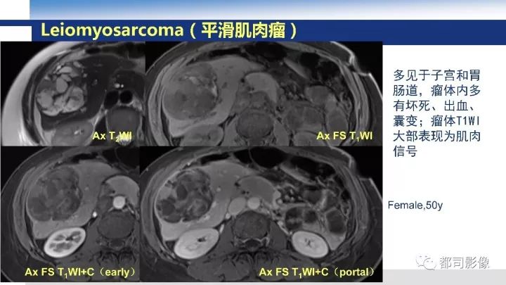 【病例】右腋下滑膜肉瘤1例影像诊断