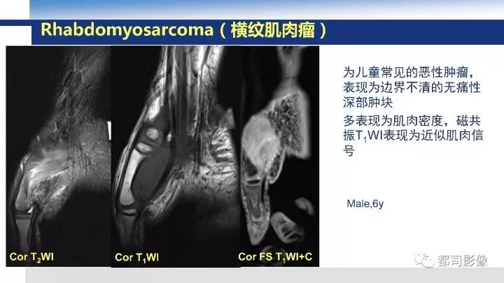 【病例】右腋下滑膜肉瘤1例影像诊断