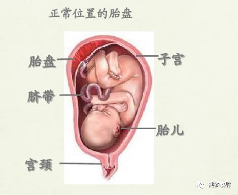 前置胎盘与胎盘植入