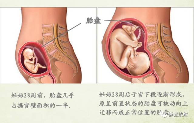 前置胎盘与胎盘植入