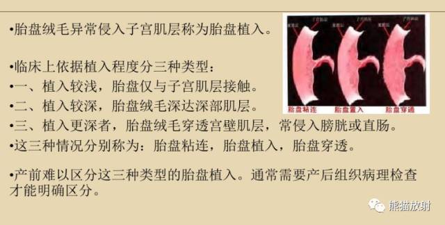 前置胎盘与胎盘植入