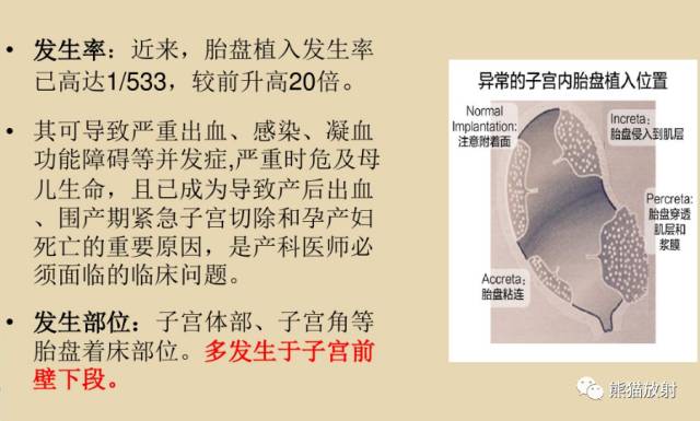 前置胎盘与胎盘植入