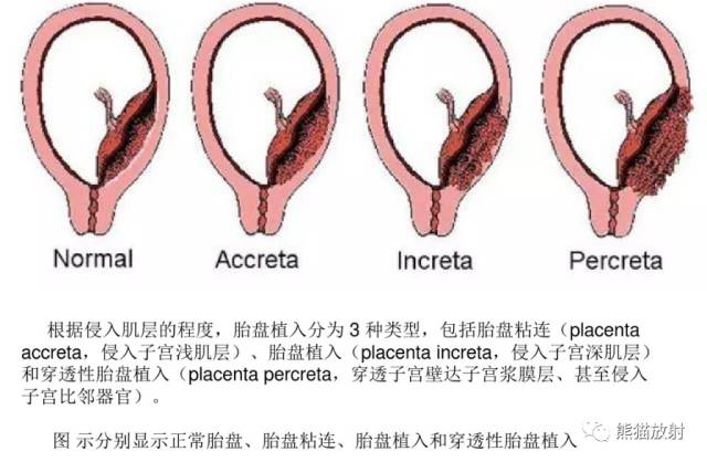 前置胎盘与胎盘植入