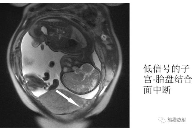 前置胎盘与胎盘植入