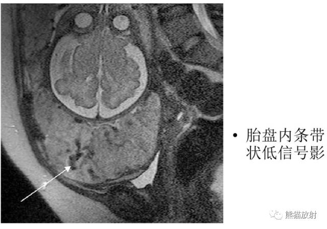 前置胎盘与胎盘植入