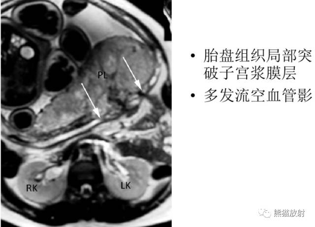 前置胎盘与胎盘植入