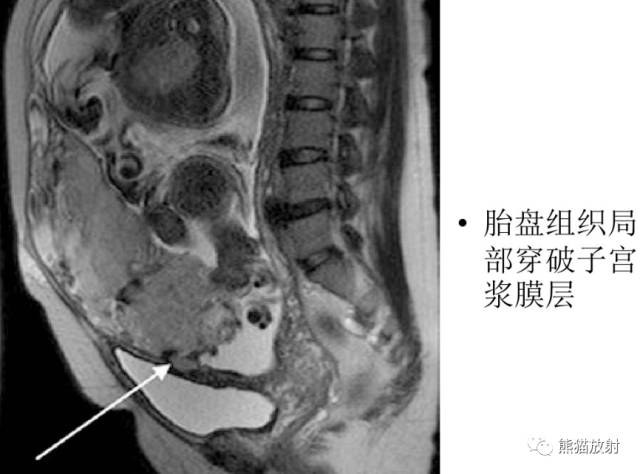 前置胎盘与胎盘植入