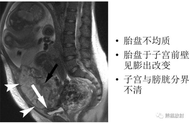 前置胎盘与胎盘植入