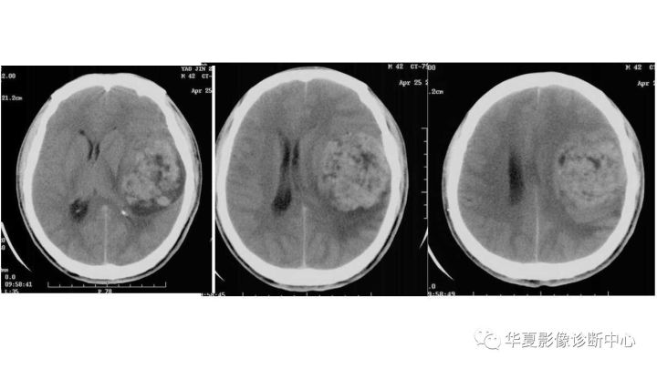 【病例】左颞部微囊型脑膜瘤1例CT及MR影像表现