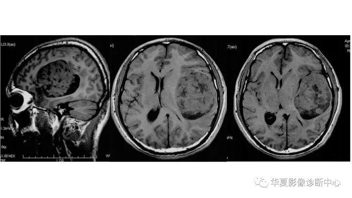 【病例】左颞部微囊型脑膜瘤1例CT及MR影像表现