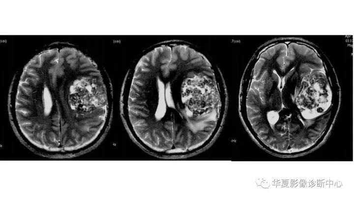 【病例】左颞部微囊型脑膜瘤1例CT及MR影像表现