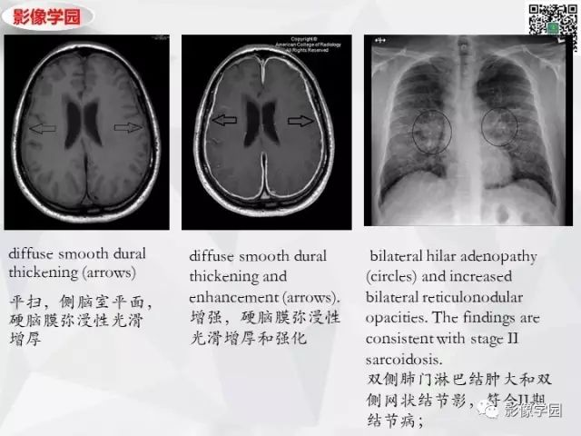 【病例】神经系统结节病1例MR 【病例】神经系统结节病1例MR