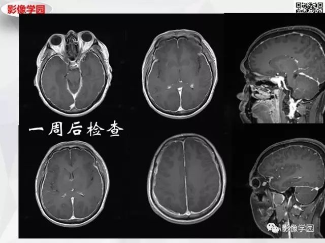 【病例】神经系统结节病1例MR 【病例】神经系统结节病1例MR