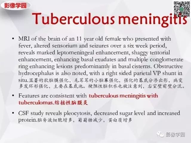 【病例】神经系统结节病1例MR 【病例】神经系统结节病1例MR