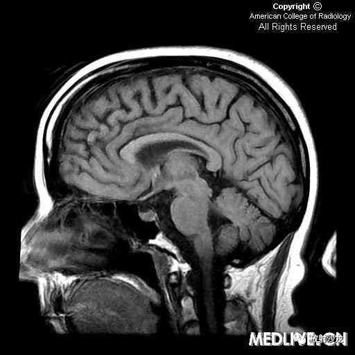【病例】显性遗传性脑血管病伴皮质下梗死和白质脑病CADASIL一例MR