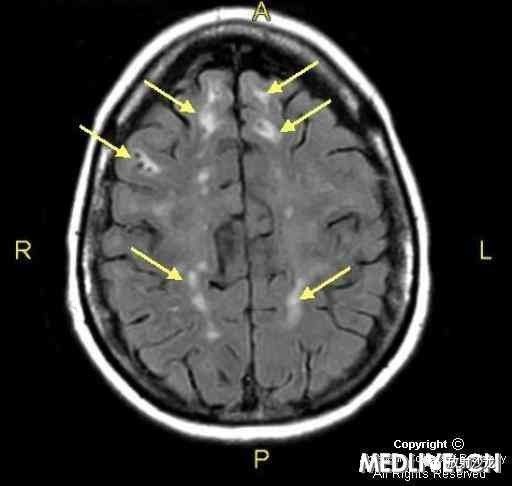 【病例】显性遗传性脑血管病伴皮质下梗死和白质脑病CADASIL一例MR