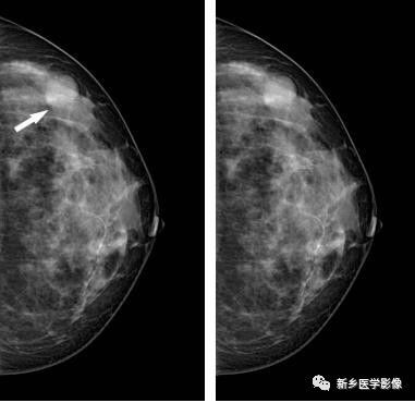 乳腺9大基本病变,必须掌握的基础 乳腺9大基本病变,必须掌握的基础