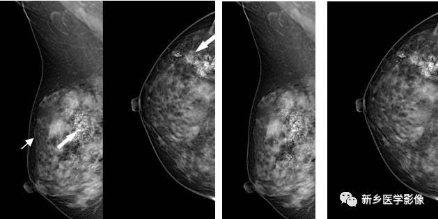 乳腺9大基本病变,必须掌握的基础 乳腺9大基本病变,必须掌握的基础