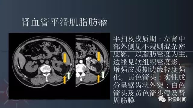 【PPT】肾脏含脂肪病变螺旋CT诊断思路
