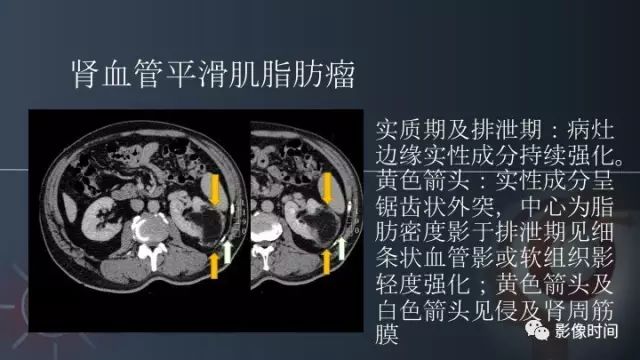 【PPT】肾脏含脂肪病变螺旋CT诊断思路