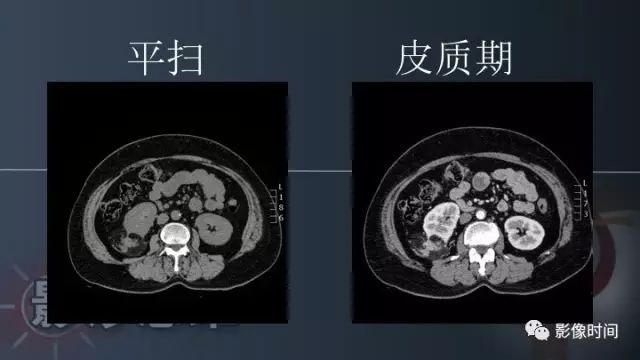 【PPT】肾脏含脂肪病变螺旋CT诊断思路