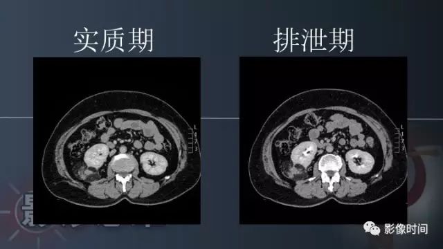 【PPT】肾脏含脂肪病变螺旋CT诊断思路