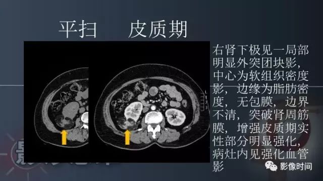 【PPT】肾脏含脂肪病变螺旋CT诊断思路
