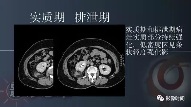 【PPT】肾脏含脂肪病变螺旋CT诊断思路