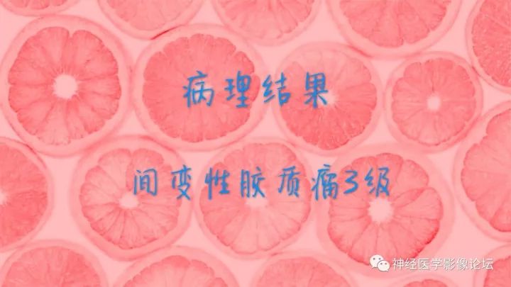 【病例】右侧脑室间变性胶质瘤1例MR