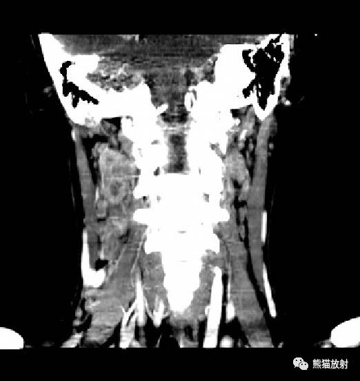 【双语病例】淋巴结结核1例CT及MRI表现与鉴别诊断