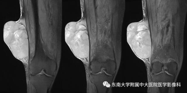 【病例】右侧大腿恶性纤维组织细胞瘤1例